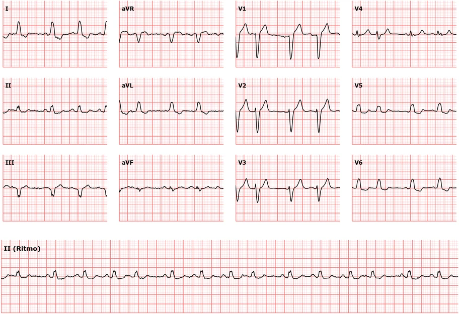Leitura de ECG